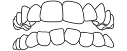 Dentes apinhados