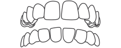 Diastema